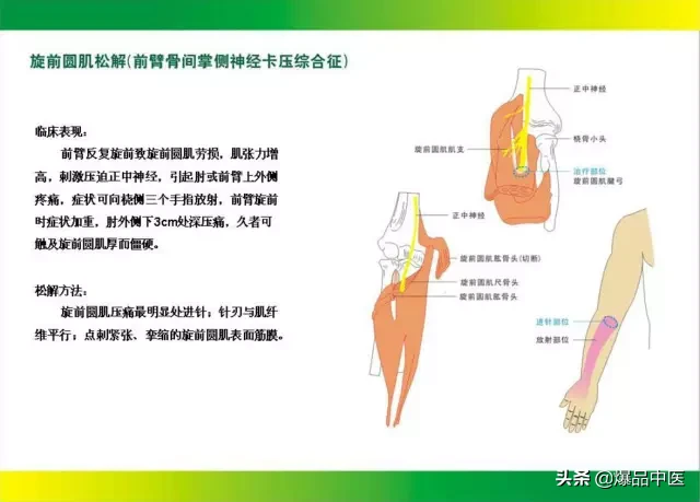 针刀治疗图解