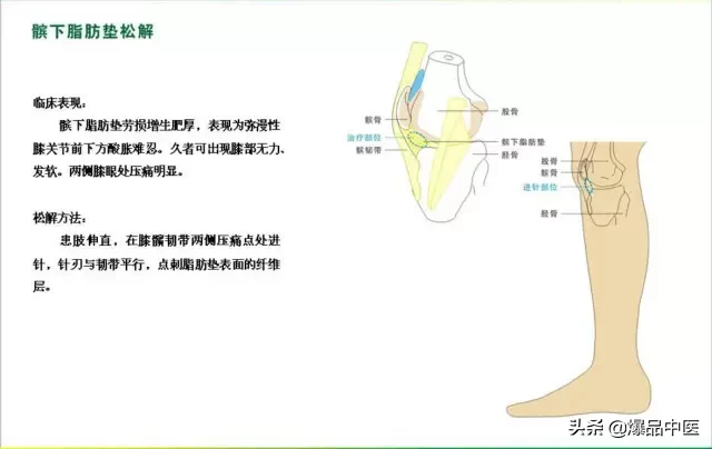 针刀治疗图解