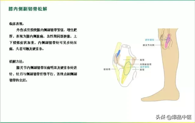 针刀治疗图解