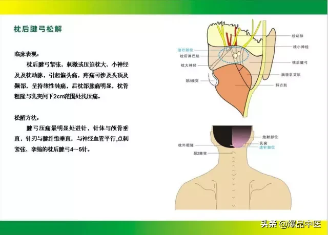 针刀治疗图解