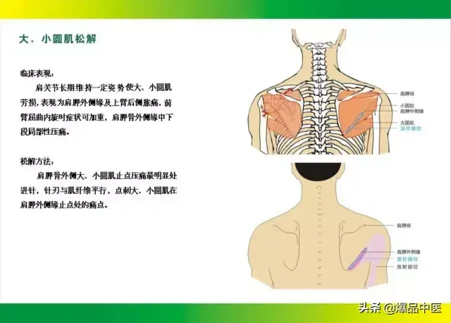 针刀治疗图解