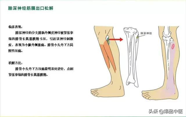 针刀治疗图解