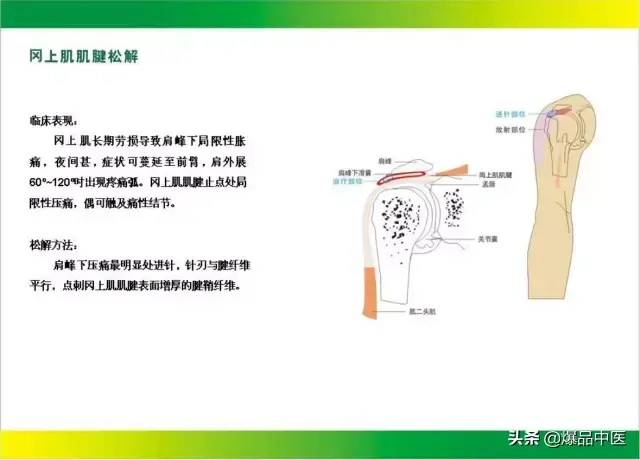 针刀治疗图解