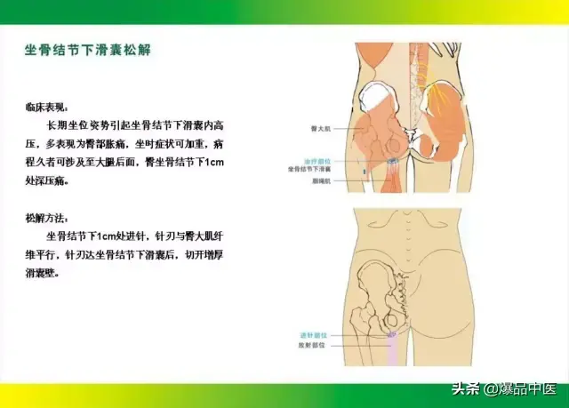 针刀治疗图解