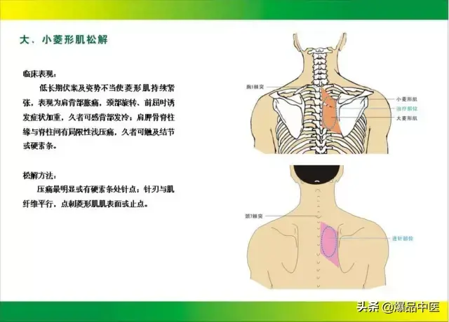 针刀治疗图解