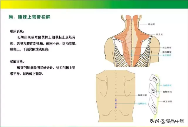 针刀治疗图解