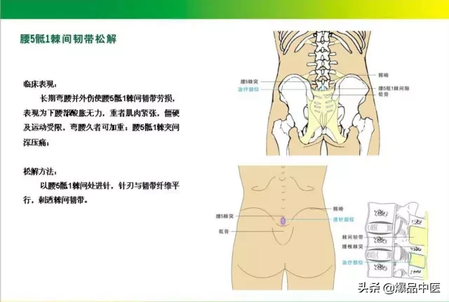 针刀治疗图解