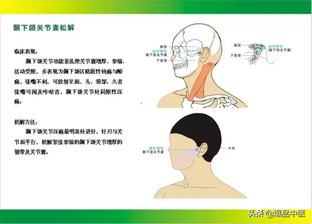 针刀治疗图解