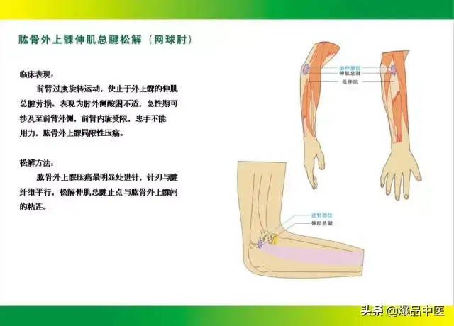 针刀治疗图解