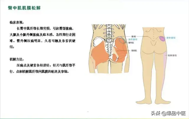 针刀治疗图解