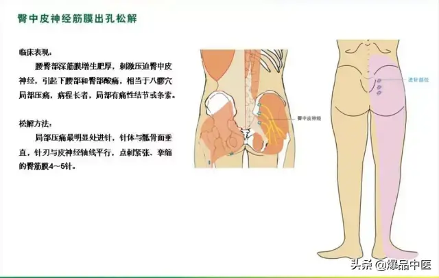 针刀治疗图解