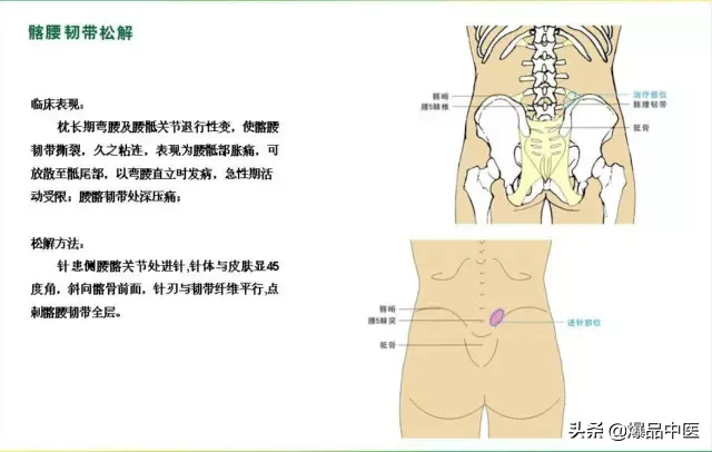 针刀治疗图解