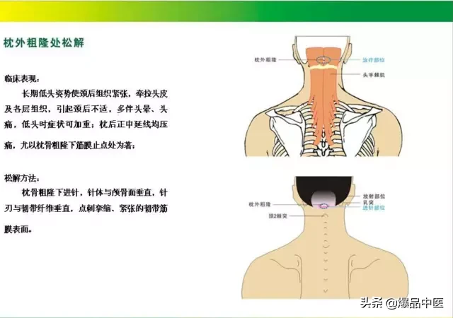 针刀治疗图解