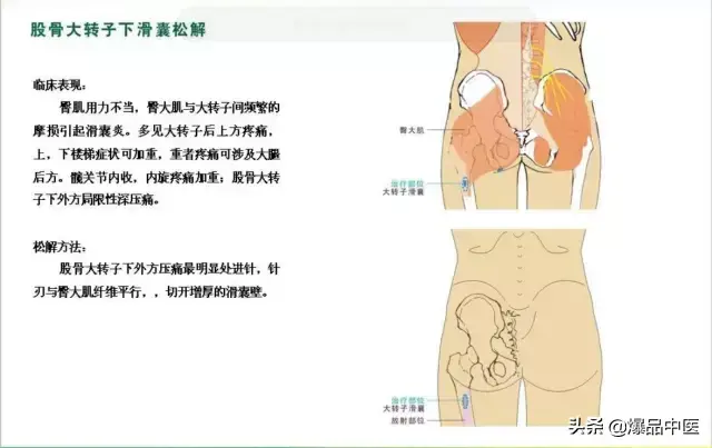 针刀治疗图解