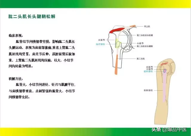 针刀治疗图解