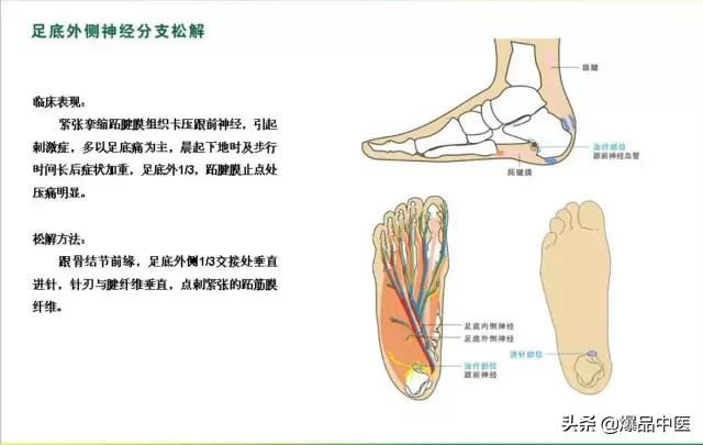 针刀治疗图解