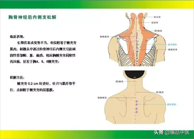 针刀治疗图解