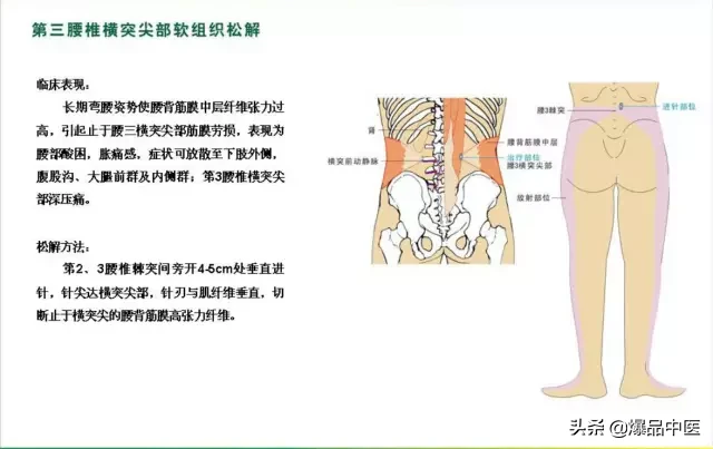 针刀治疗图解