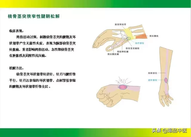 针刀治疗图解