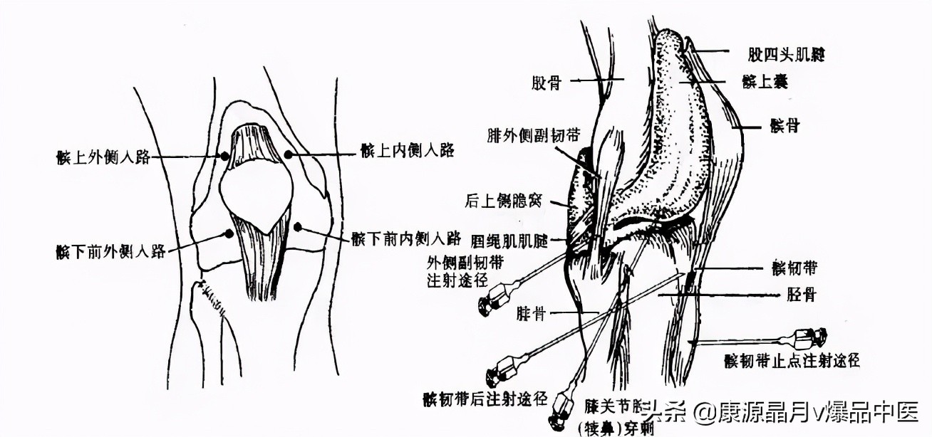 常用关节腔穿刺方法技巧大全