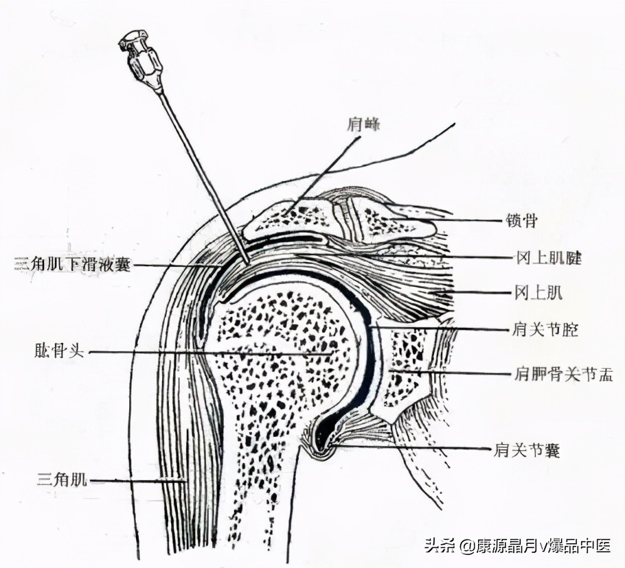 常用关节腔穿刺方法技巧大全