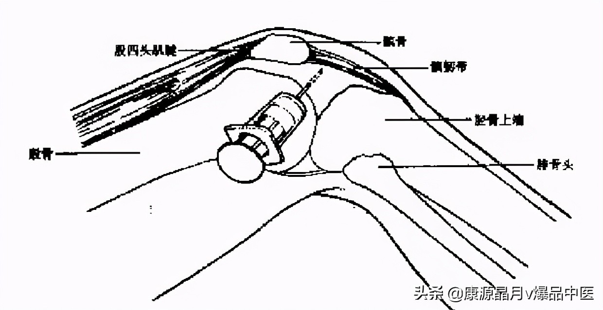 常用关节腔穿刺方法技巧大全