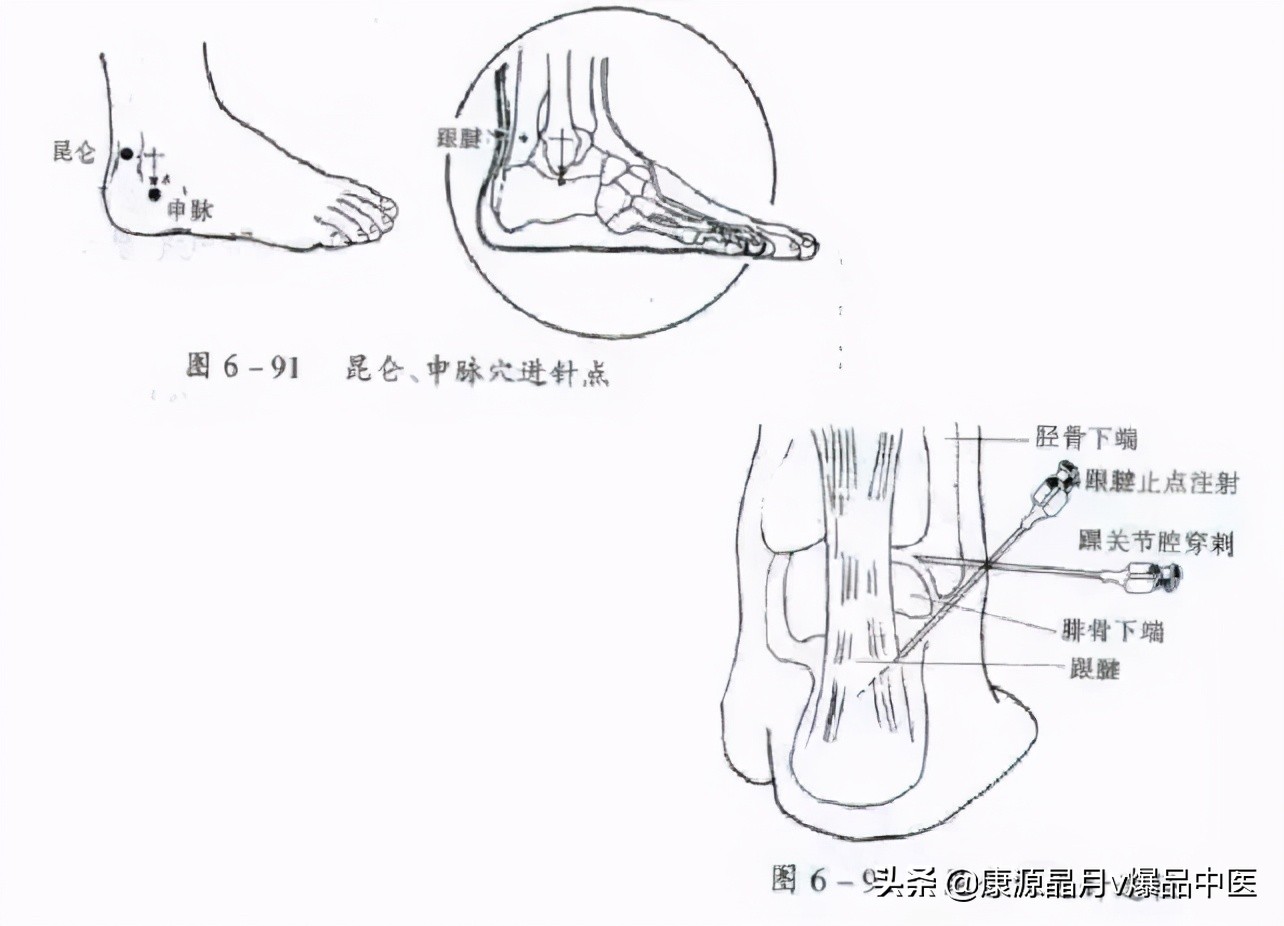 常用关节腔穿刺方法技巧大全