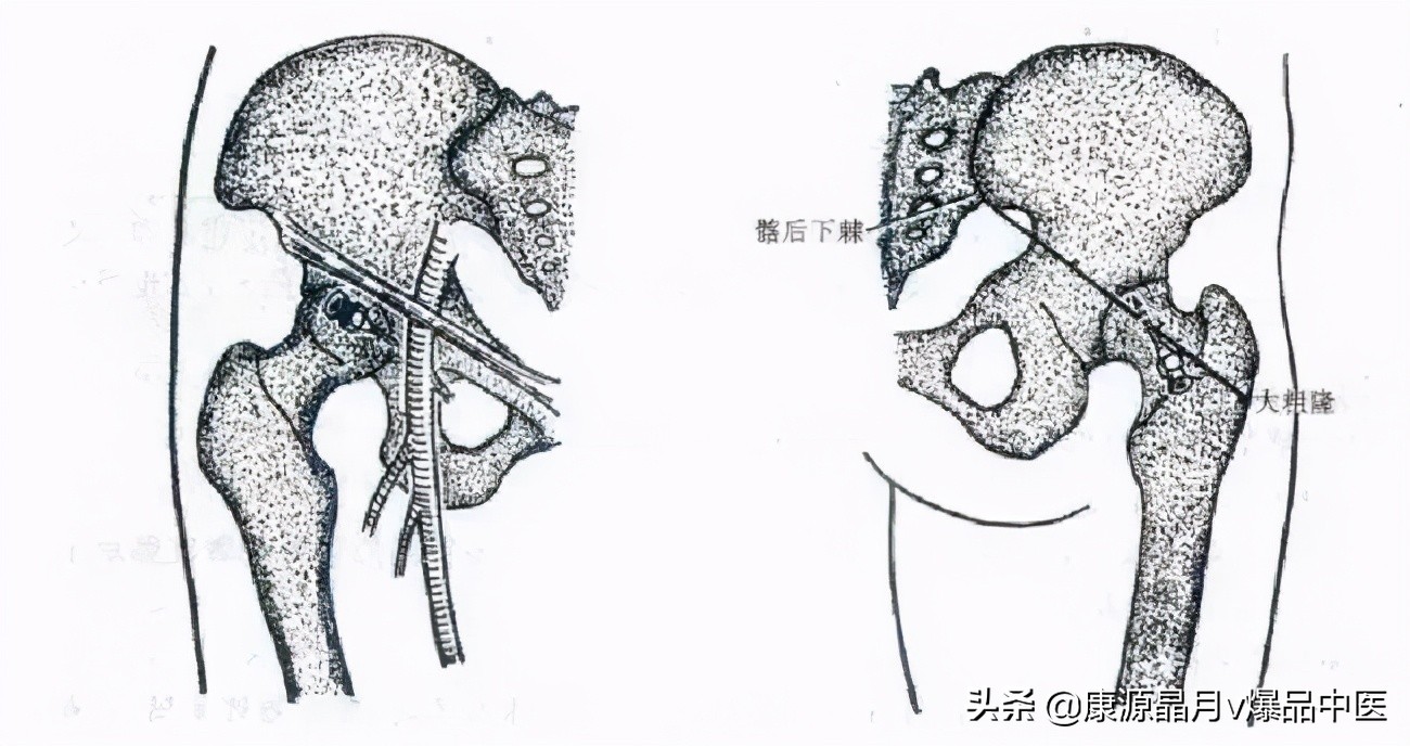 常用关节腔穿刺方法技巧大全