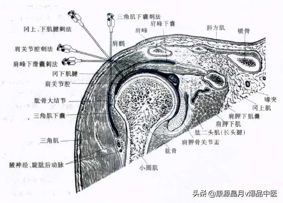 常用关节腔穿刺方法技巧大全