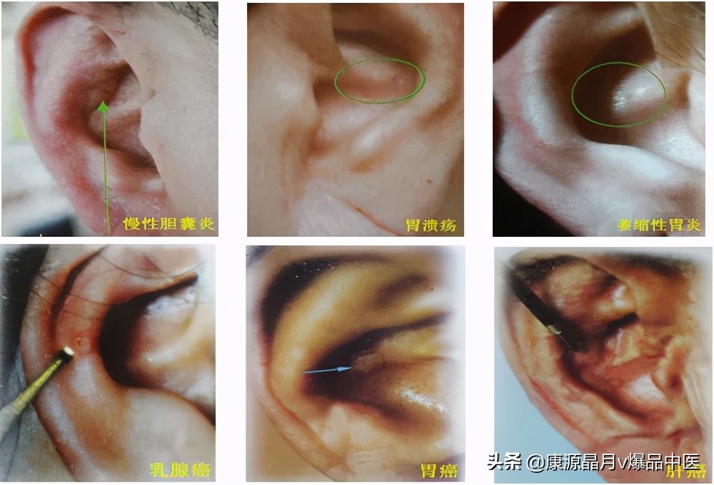 耳朵上出现这些特征，是大病的征兆