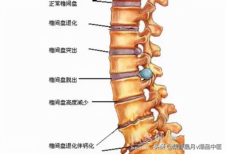 腰间盘突出症不花钱、最简单的治疗方式