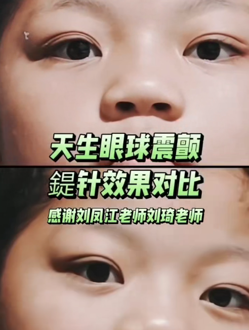 小姑娘天生眼球震颤，三次鍉针的效果