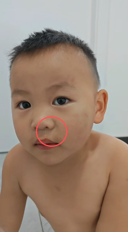 小儿着凉流鼻涕，提针技术，分分钟解决问题