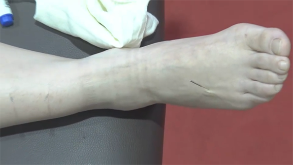 乳腺结节，这几个穴位，超好用！