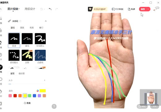 手诊与手针的完美结合