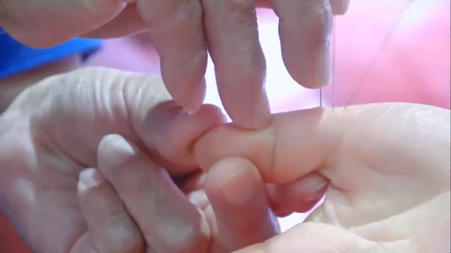 这组穴位，手脚同治，细节很重要，收藏备用！