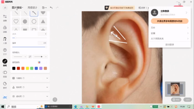 飞蚊症，一个点位，立竿见影！
