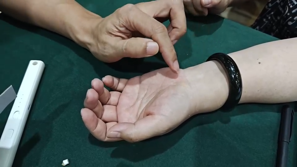 偏头痛，实战组方，超好用！